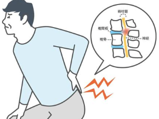 【椎間板ヘルニアとは？】メカニズム・症状・治療・対策を解説！！